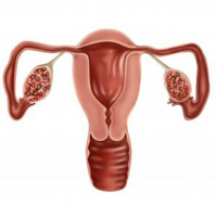 What are the cardial feature for diagnoss of PCOS?