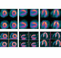 What are the various protocols for nuclear myocardial studies?