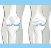 What is Osteoarthritis?