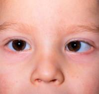 What is Strabismus or Squint?