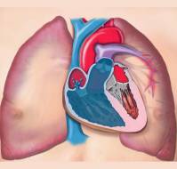 What is balloon arterial septostomy?