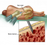 What is bone marrow culture?