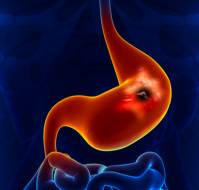 पेप्टिक अल्सर रोग क्या है? कारण, लक्षण और इलाज | Peptic Ulcer Disease in Hindi