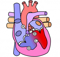 What is the tetralogy of fallot?