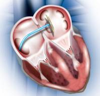 When should ASD closure be done?