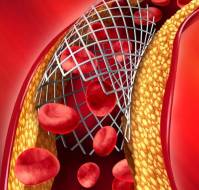 When should we use bare metal stents in acute MI?