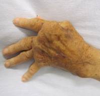 When should we start biologics Rheumatoid Arthritis?