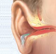 Why does the ear keep discharging even after ear surgery?