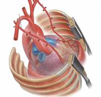 When should we go in for a total arterial bypass surgery?