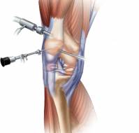 What is the role of arthroscopy in osteoarthritis knee?