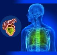 What is the management of acute respiratory distress syndrome (ARDS)?