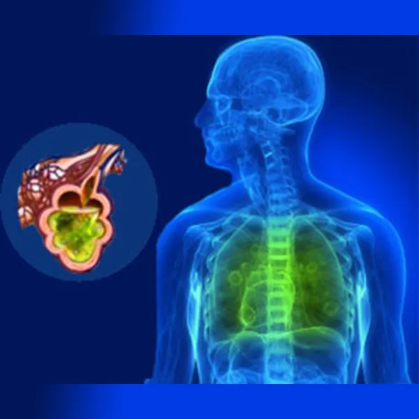 What is the management of acute respiratory distress syndrome (ARDS)?
