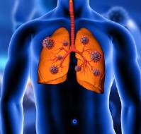 बैक्टीरियल निमोनिया क्या है? कारण, लक्षण और इलाज | Bacterial Pneumonia in Hindi
