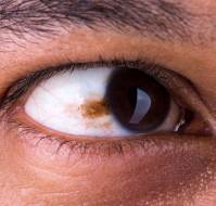 आँख का कैंसर क्या है? | Eyes Cancer in Hindi