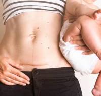 Cesarean Delivery (C-Section): All You Must Know