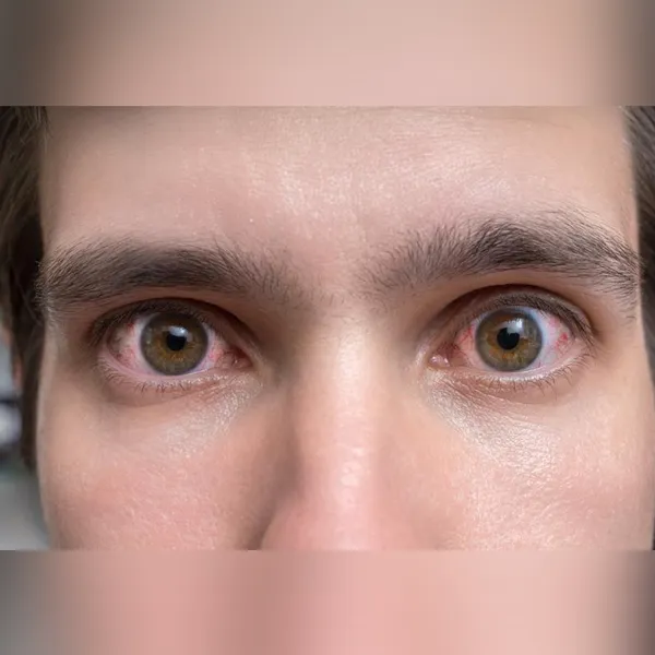 What are the common retinal diseases?