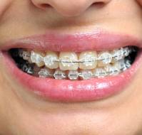 What everybody should know about dental braces?