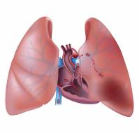 How is pulmonary embolism diagnosed?