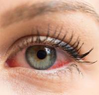 Dry eyes - Symptoms, Causes and Treatment | Medtalks