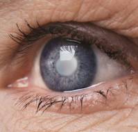 ग्लूकोमा यानि काला मोतिया कैसे गंभीर | Glaucoma in Hindi