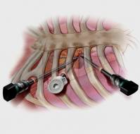 What is Minimal Invasive Heart Bypass Surgery treatment?