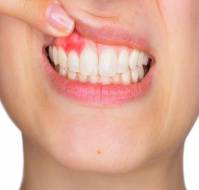 What everybody should know about gum disease?