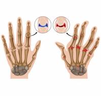 How is Rheumatoid arthritis confirmed? How is Rheumatoid arthritis treated?