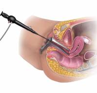 What is the role of hysteroscopy in infertility?