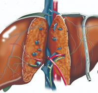 Liver Transplantation: Procedure, Eligibility, and Postoperative Care