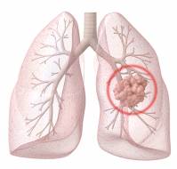 What is Lung Cancer? | Types of Lung Cancer |  Symptoms and causes