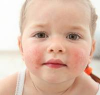 Mouth breathing and skin disease in children?
