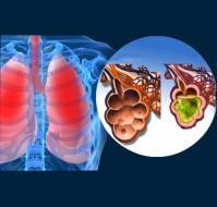 What is the management of acute respiratory distress syndrome (ARDS)?