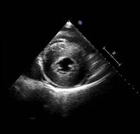 What is the importance of LVH on echocardiography?