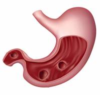 What is the management of peptic ulcer disease?