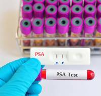 When should we do screening PSA?