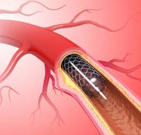 What are the second generation stents?