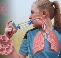 What is the formula of two to classify the severity of asthma?