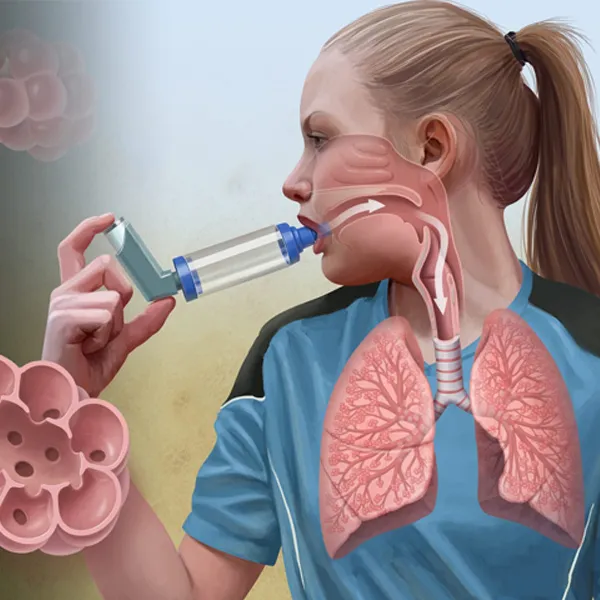 What is the formula of two to classify the severity of asthma?