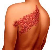 शिंगल्स क्या है? कारण, लक्षण और इलाज | Shingles in Hindi