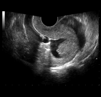 What is sonohysterogram in infertility?