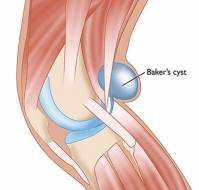 बेकर्स सिस्ट क्या है? कारण, लक्षण और उपचार 