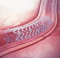 What is the role of absorbable stents in acute MI?