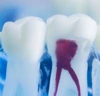 What everybody should know about teeth as a source of coronary artery disease?