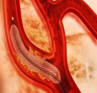 What are the third generation stents?