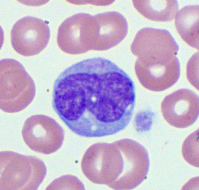 मोनोसाइटोसिस क्या है? कारण, लक्षण और इलाज | What is Monocytosis in Hindi