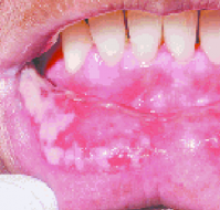 म्यूकोसाइटिस क्या है? कारण, लक्षण और इलाज | What is Mucositis in Hindi