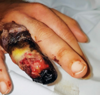 नेक्रोसिस क्या है? | What is Necrosis in Hindi
