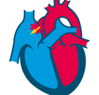 What is atrial septal defect (ASD)?