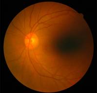 What is Retina?