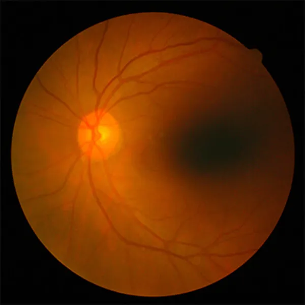 What is Retina?